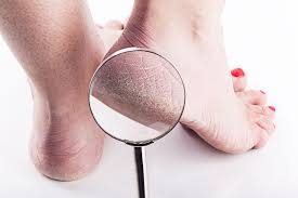 Is usually scaly skin if you look closely many times there is a ring or small circle with the center people also searched for: A Podiatrist S Recommendations How To Get Rid Of Dry Cracked Feet Hyprocure The Proven Solution To Misaligned Feet