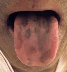 Image result for black tongue symptoms