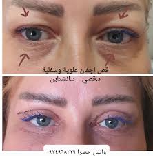 قص اجفان علوية وسفلية معا اصغر بعشر سنوات بنصف ساعة 👍 عملية الاجفان عملية  بسيطة تتم تحت التخدير الموضعي بدون الم يتخرج المريض مباشرة ...تزول الوزمة  بعد ٥ ايام ...تفك القطب بعد