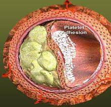 Crush the garlic and let it sit for 15 minutes. How To Remove Plaque From Arteries Naturally What Causes High Cholesterol Plaque Removal Arteries