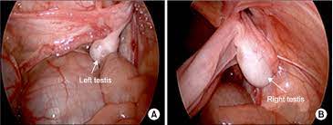 Transverse Testicular Ectopia With Persistent Mullerian Duct Syndrome Download Scientific Diagram