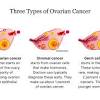 Ovarian epithelial cancer is the most common type of ovarian cancer. 1