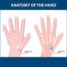 Hydatid liver cyst along with tears and anterior cruciate ligament ganglion cyst s, mucoid degeneration is a relatively. Ganglion Cysts Information Florida Orthopaedic Institute