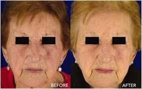 Full article: Clinical, histopathological and immunohistochemical  evaluation of daylight photodynamic therapy in the treatment of field  cancerization: a study of 30 cases