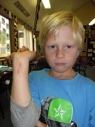 Room 14 Arrowtown School: Aiden's Accident