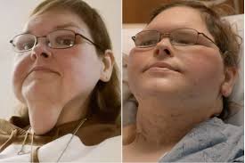 Tammy's Skin Removal Surgery Reactions