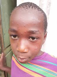 BOLOOTHONG 2017. An Attack of Chicken Pox to Adults Can Produce Serious  Complications and It Has Concerned Me More Than Those Itchy Blister Rashes  Themselves. This is the Worst Nightmare for Those