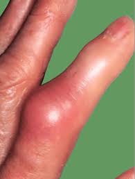 Image result for Septic Joint