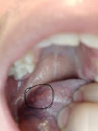 Image result for Puchýře na jazyku