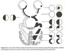Image result for Visual Field Deficit