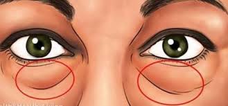 Voici Les Meilleurs Traitements Naturels Pour Enlever Les Cernes Et Poches Sous Les Yeux Gozler Mor Dogal