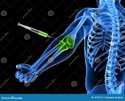 Image result for Elbow Joint Injection