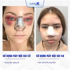 Phẫu Thuật Nâng Mũi Nội Soi 4K Vi Phẫu: Ưu Điểm Và Chi Phí