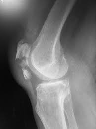Patella Fracture Lateral X Ray Knee Injury Patella Fracture Medical Knowledge