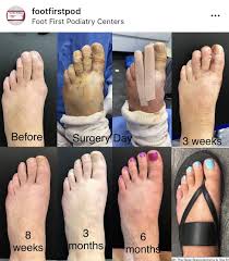 Worth The Results Hand Foot And Mouth Hammer Toe Surgery Bunion Surgery