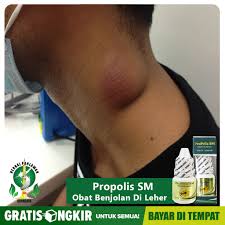 Pesan langsung obat herbal benjolan di leher qnc jelly gamat klik disini bit.ly/qncmelayudeli qnc jelly gamat adalah. Obat Benjolan Di Leher Kelenjar Getah Bening Bengkak Tbc Kelenjar Propolis Sm Bisa Cod Free Ongkir Shopee Indonesia