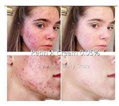 New Retinol Vitamin A 0 05 Cream Gel Retin Acne Anti Wrinkles Blemish Treatment 10g Facial Self Tanners Bronzers Aliexpress Levin is here to break things down. new retinol vitamin a 0 05 cream gel retin acne anti wrinkles blemish treatment 10g