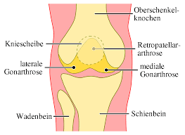 Kniegelenksarthrose Wikipedia