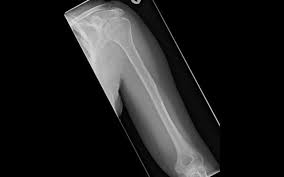 Woman S Bones Vanish Before Doctors Eyes Bones Show Bone Diseases Bones