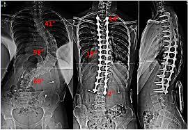 We did not find results for: Pediatric Scoliosis Surgery Guide