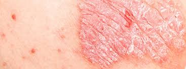 Guttate Psoriasis Pictures Home Remedies Causes Symptoms