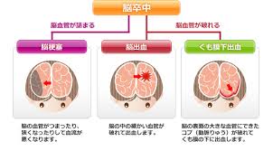 The site owner hides the web page description. è„³å'ä¸­ã¨ã¯ Tmgã‚ã•ã‹åŒ»ç™‚ã‚»ãƒ³ã‚¿ãƒ¼ è„³ç¥žçµŒå¤–ç§'