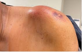 Image result for Septic Joint