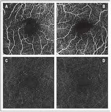 Symptoms of this condition include blurry vision, dark spots, and objects looking. Retinal Sequelae Of Novel Oncology Drugs
