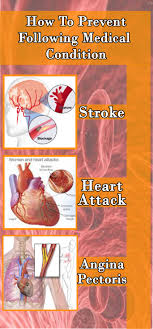 Stroke Heartattack Medical Condition Healthyliving Healthcare Livehappy Health Corner Health And Wellness Fitness Nutrition