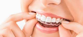 Invisalign ® treatment is a series of clear plastic removable orthodontic aligners that gently move patients' teeth. Invisible Braces Sydney From 1650 99 No Gap Dentists