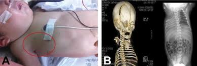 Polandův syndrom (poland syndrom) a příčiny. Rare Combination Of Dextrocardia With Right Sided Poland Syndrome The Annals Of Thoracic Surgery