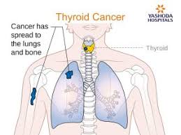Safe and effective with 5 natural ingredients. Endocrinal Dysfunctions Thyroid Cancer Symptoms Diagnosis And Treatments
