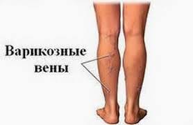 как лечить варикоз на ногах у женщин в домашних условиях Varikoz Varikoz V Domashnih Usloviyah Varikoznoe Rasshirenie Ven Varikoznoe Rasshirenie Ven Lechenie Varikoznoe Rasshirenie Ven Narodnye Sred Zdorove Pinte