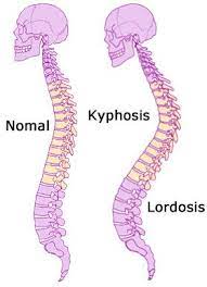 What Is Scoliosis Non Surgical Scoliosis Scoliosis Musculoskeletal System Spine Health