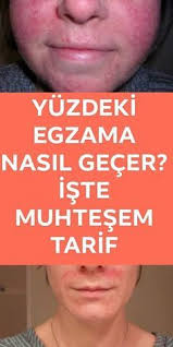 Yuzdeki Egzama Nasil Tedavi Edilir 2020 Saglik Cilt Rengi Cilt Urunleri