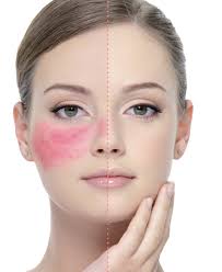 Résultat de recherche d'images pour "rosacea"