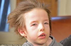 Terminal copper deficiency Menkes film unites families