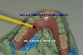 A quick look online will find you companies that offer do it yourself dentures kits. Same Day Denture And Partial Repair