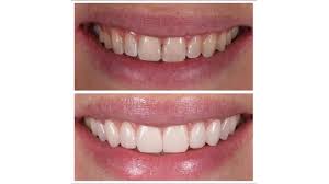 The.gov means it's official.federal government websites often end in.gov or.mil. Us Top 8 Cosmetic Dentists Surgeons To Achieve Perfect Smile Newsbytes