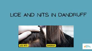 Image result for lice vs dandruff