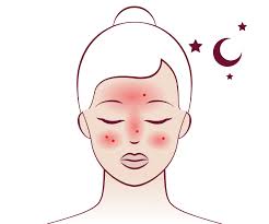 IPL for Rosacea & Acne