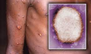Monkeypox virus — a virus of the genus orthopoxvirus that produces a mild, epidemic, exanthematous disease in monkeys and a smallpox like disease in humans … Monkeypox Virus Uk Symptoms And Signs Risk In The World Revealed Express Co Uk