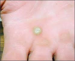 Warts are the cutaneous manifestations of human papilloma virus (hpv) that may exist in different the use of oral acitretin in the treatment of recalcitrant warts is under studied in literature where. Cutaneous Warts An Evidence Based Approach To Therapy American Family Physician