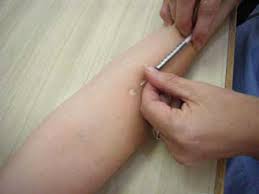 How to administer a tst by the mantoux method: Tuberculin Skin Test