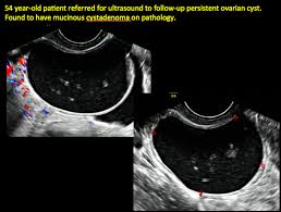 The risk of a cyst becoming cancer is higher in people who have been through if the doctor discovers an ovarian cyst during the ultrasound, they may request additional ultrasound scans to continue monitoring the cyst. Imaging The Suspected Ovarian Malignancy 14 Cases Mdedge Obgyn