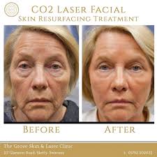A fabulous skin rejuvenation result here from the Team at The Grove Skin &  Laser Clinic using their #CO2RE CO2 Laser. Repost "What is CO2?... Laser  resurfacing is one of the most