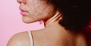 Can you reduce high creatinine levels naturally? What Causes Red Spots On Skin Dermatologists Explain