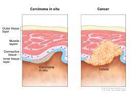 Calcium is a mineral found in different places in the body, including your blood. Definition Of Carcinoma In Situ Nci Dictionary Of Cancer Terms National Cancer Institute