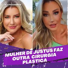 Após trocar as próteses de silicone e realizar uma lipo de papada, Ana  Paula Siebert, 33, mulher de Roberto Justus, resolveu mudar o nariz .. .  Veja o antes (esq)) e o