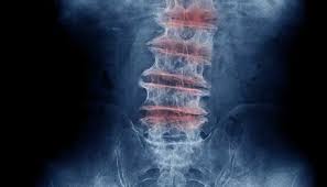 Lower right back pain is one of the most common health issues that you can find out there. Lumbar Spinal Stenosis Johns Hopkins Medicine